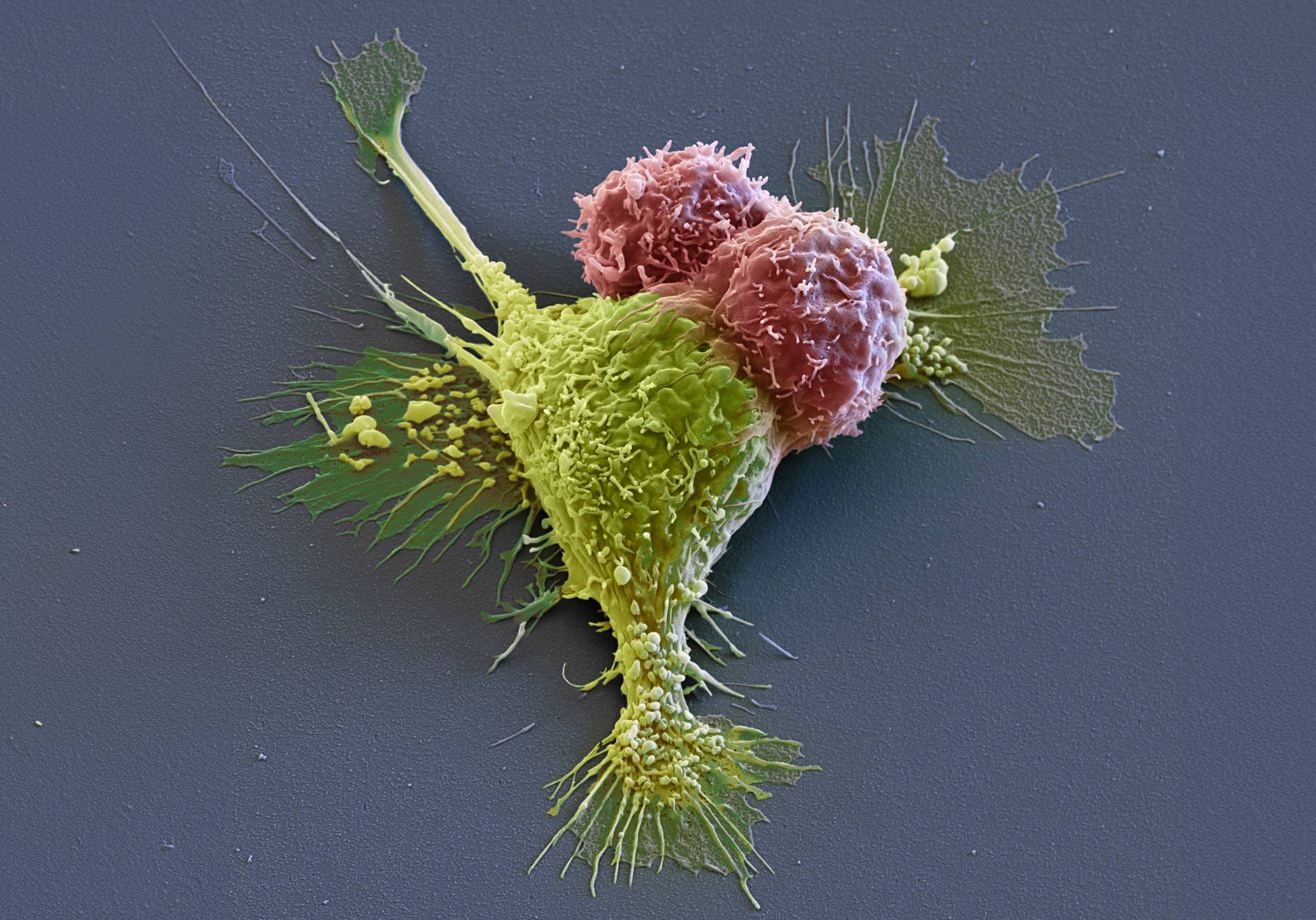 la révolution des thérapies CAR-T, dans epsiloon, le magazine scientifique d'actualité